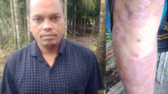 মনপুরায় চর্মরোগে আক্রান্ত মো অহিদের জন্য গণঅধিকার পরিষদের আর্থিক সাহায্য চেয়ে দেশবাসীর কাছে আবেদন