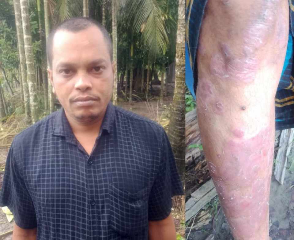 মনপুরায় চর্মরোগে আক্রান্ত মো অহিদের জন্য গণঅধিকার পরিষদের আর্থিক সাহায্য চেয়ে দেশবাসীর কাছে আবেদন